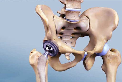 جراحة استبدال المفاصل